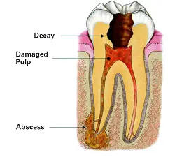 Human Teeth Treatment of Dental Dam