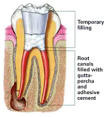 Human Teeth Treatment of Temporary Filling