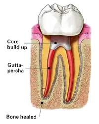 Human Teeth Treatment of Core Build Up