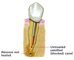 Human Teeth Treatment of Untreated Calcified