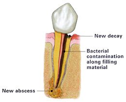 Human Teeth Treatment of Bacterial Contamination Along With Filling Material