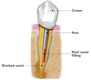 Human Teeth Treatment of Root Canal Filling