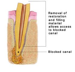 Human Teeth Treatment of Removal of Restoration and Filling Material