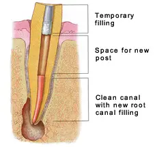Human Teeth Treatment of Temporary Filling
