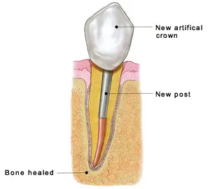 Human Teeth Treatment of Artificial Crown