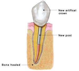 Human Teeth Treatment of Artificial Crown